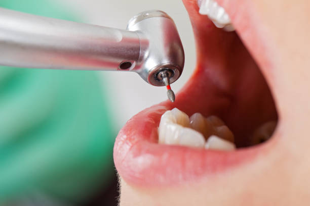 Best Emergency Tooth Extraction in Bellefontaine, OH